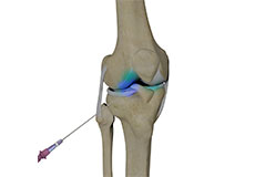 Intra-articular Injections