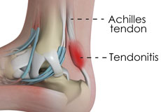 Achilles Tendinitis