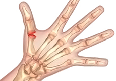 Arthritis of the Hand and Wrist