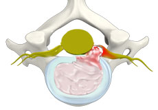 Herniated Disc (Cervical)