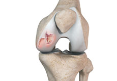Chondral or Articular Cartilage Defects 