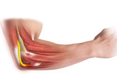 Cubital Tunnel Syndrome (Ulnar Nerve Entrapment)