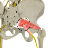 Deep Gluteal Pain Syndrome