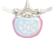 Degenerative Disc Disease