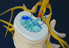 Disc Herniation