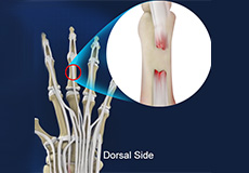 Extensor Tendon Injuries 