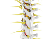 Facet Joint Arthritis