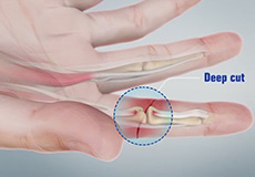 Flexor Tendon Injuries