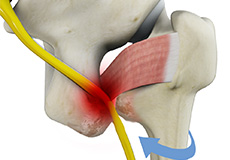 Ischiofemoral Impingement