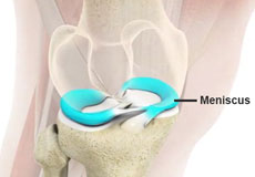 Meniscal Tears