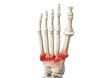 Midfoot Arthritis