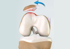 Patellofemoral Instability