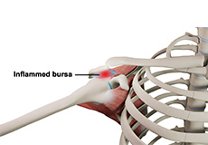 Rotator Cuff Bursitis