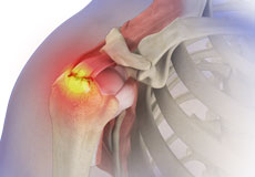 Rotator Cuff Injury