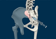 Sacroiliac Joint Injections 