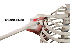 Shoulder Bursitis