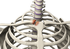 Sternoclavicular Arthritis