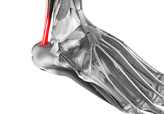 Tendinopathies