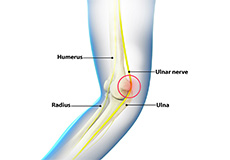 Ulnar Nerve Neuritis