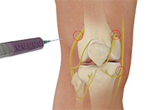 Ultrasound-Guided Genicular Nerve Block
