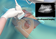 Ultrasound Guided Hip Injections