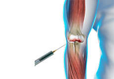 Viscosupplementation for Elbow Arthritis